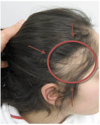 Cột tóc chặt làm tăng khả năng rụng tóc phụ nữ sau sinh vì chân tóc bị kéo căng, dễ rụng