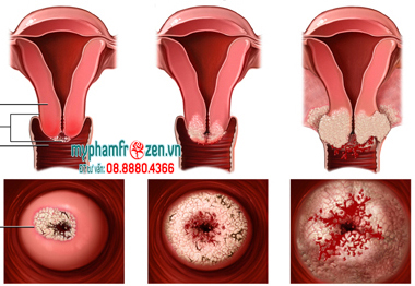 Hình ảnh bệnh viêm nhiễm phụ khoa - Viêm cổ tử cung