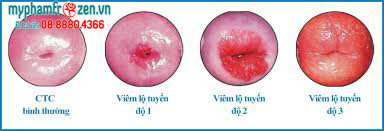 Hình ảnh bệnh viêm nhiễm phụ khoa - Các cấp độ Viêm lộ tuyến